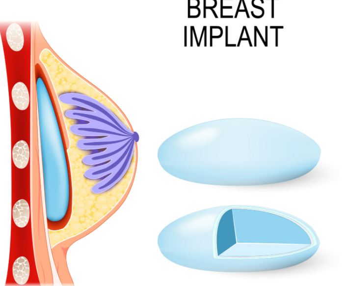 岳莉?qū)t(yī)生做隆胸價格表