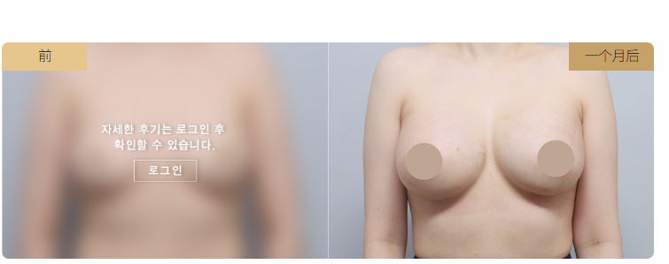 韓國喜悅整形外科假體隆胸對比圖