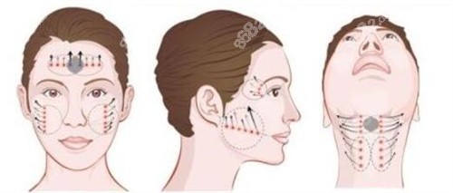 20251107235246.jpg 面部拉皮的拉皮方向動(dòng)畫(huà)演示圖.jpg