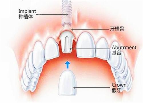 20251107363177.jpg 即拔即種示意圖.jpg