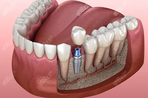 20251107451521.jpg 單顆種植牙解刨圖.jpg