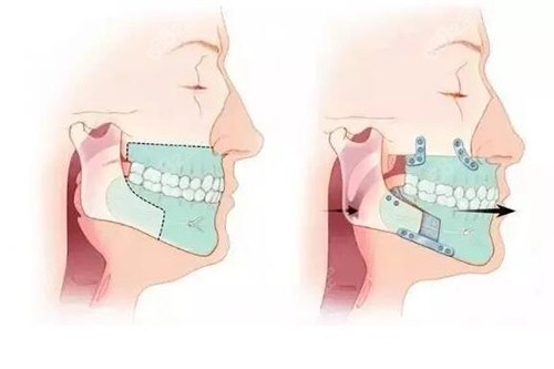 正頜手術(shù)前后 正頜手術(shù)前后