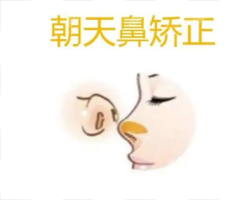 朝天鼻矯正 朝天鼻矯正