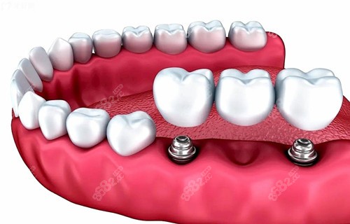 20251107788630.jpg 多顆種植牙種植模型示意圖.jpg