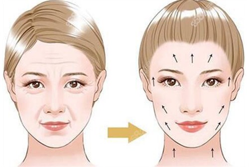 20251107897219.jpg 面部除皺術(shù)前術(shù)后對(duì)比演示動(dòng)畫(huà)圖.jpg