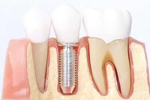 20251107932544.jpg 單顆種植牙模型圖.jpg