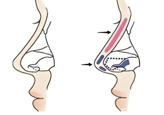 熊裕华在上海做鼻子很出名，星璨（星美）医美坐诊，主做自然风，初鼻和鼻修复都能做