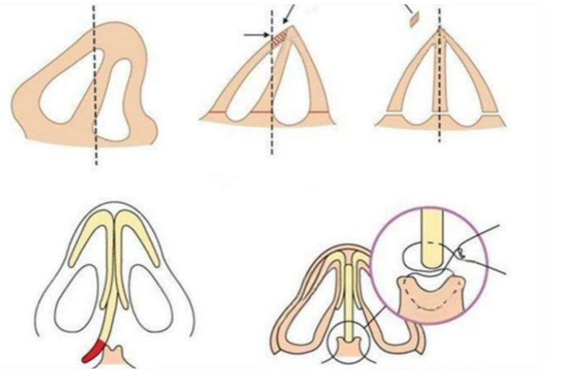 熊裕华在上海做鼻子技术优势