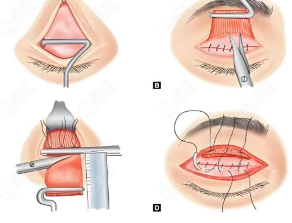 被成都李瑞萱野生范例种草！修复肉条眼 + 自然隆鼻，网友自发分享全是真实反馈