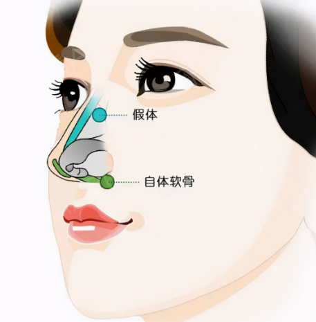 上海熊裕華做鼻子修復價位