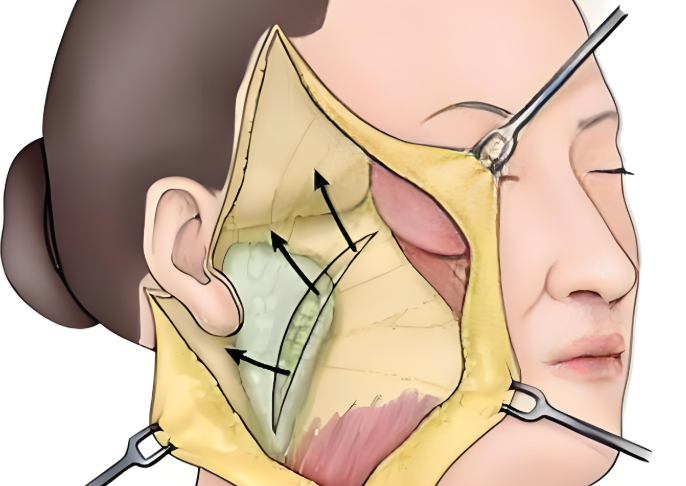 手術類皮貼骨提升