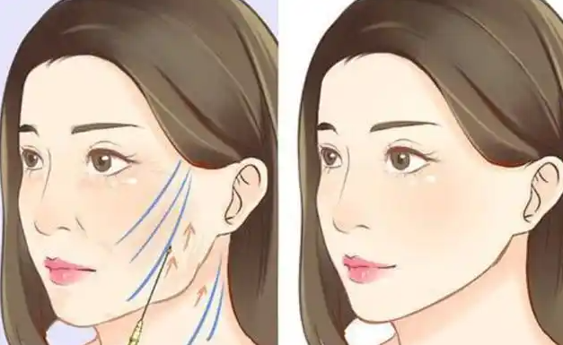 皮貼骨提升是什么項目是手術還是打針？手術錨筋膜/打針填骨膜，兩種方式