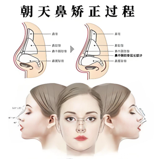 了解了一下彭鑫医生的朝天鼻矫正，好像主要是改善鼻翼和鼻孔形状？