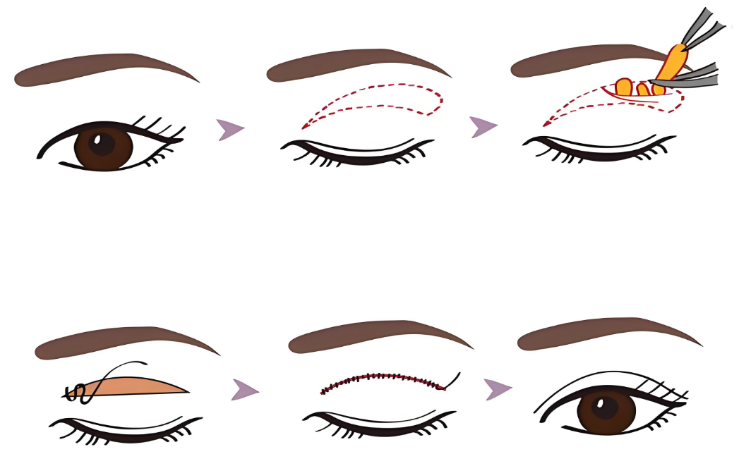 何文星专注眼整形