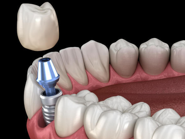 宜章植贝尔口腔各项目收费详情及特点