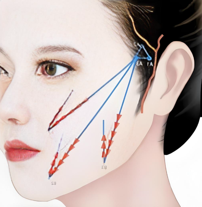 韩国筋膜提升术能维持多久