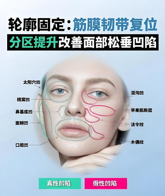 韩国筋膜提升术