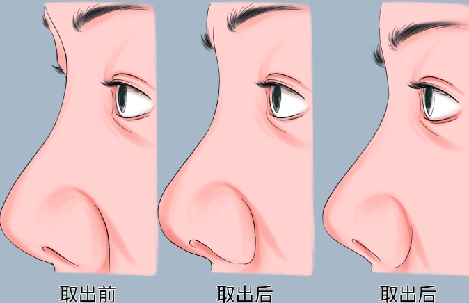 文丰做的鼻子真的不疼吗