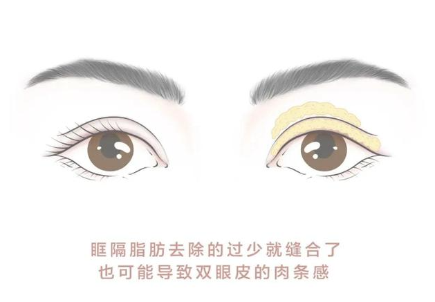 上海周美兰和朱迪修复眼睛谁好？自然保守选周美兰，朱迪更注重功能性修复