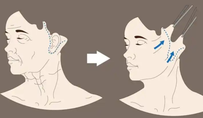 穆寶安面部提升多久消腫