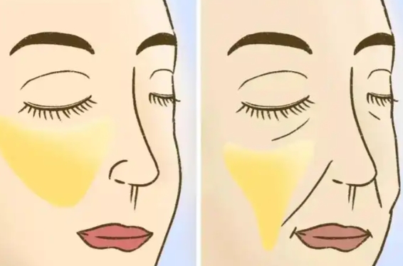 穆寶安面部提升多久消腫