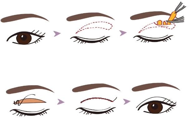 華美美萊8d雙眼皮團(tuán)購(gòu)價(jià)格