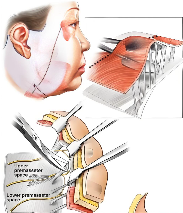 上海趙鵬筋膜懸吊一年后功效能打幾分？如果再給我一次機(jī)會(huì)，我是會(huì)選他！