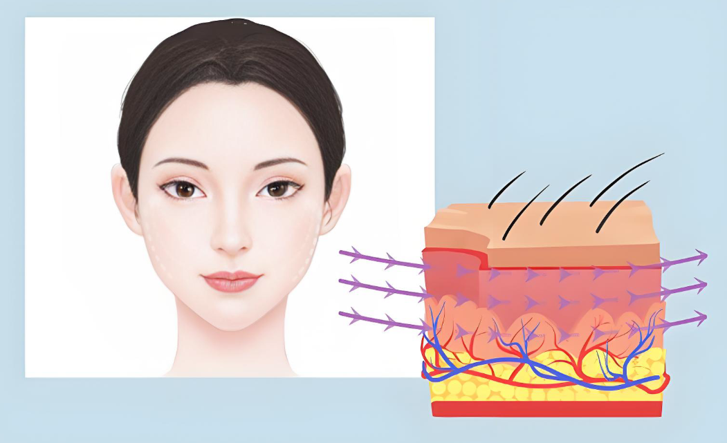 上海趙鵬雙平面提升靠譜伐？25-45歲抗衰必看：我做完一年半，臉沒垮還挺緊致！