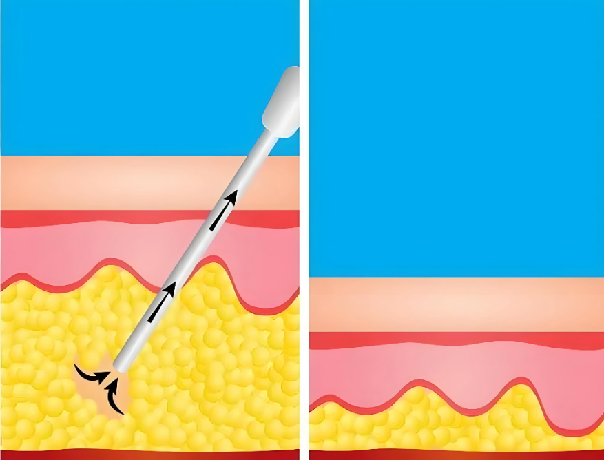深圳抽脂鐘偉洪在哪個(gè)醫(yī)院？抽脂必看：確認(rèn)了他是在深圳米蘭柏羽醫(yī)療美容坐診
