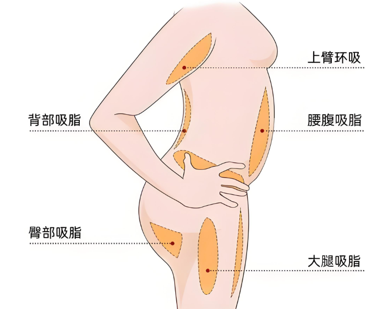 深圳抽脂鐘偉洪實(shí)例分享m.66ub.cn