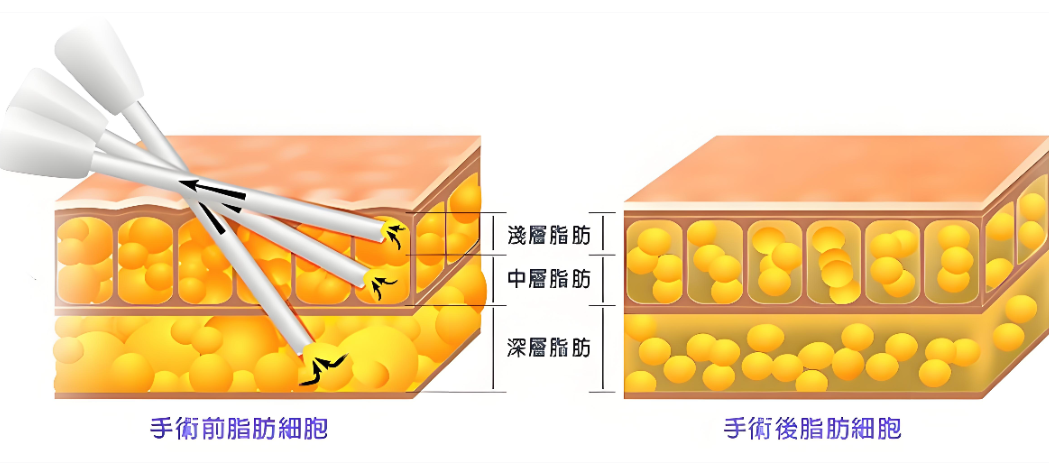 深圳钟伟洪医生吸脂技术怎么样