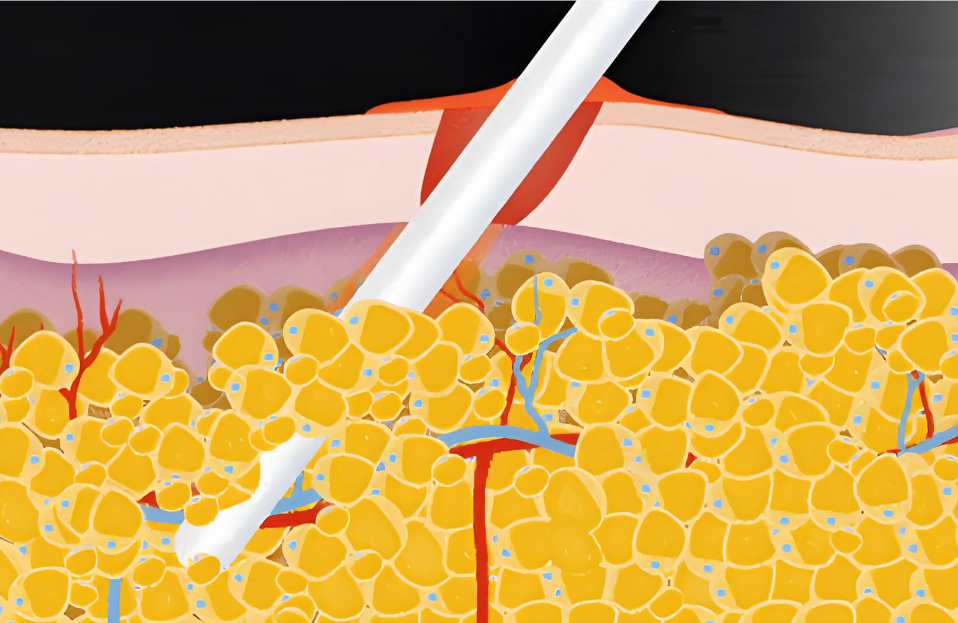 深圳钟伟洪医生吸脂