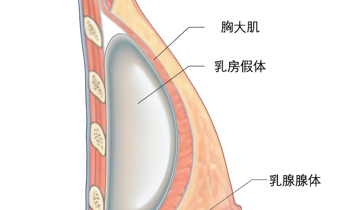 艾斯美假體和曼托假體哪個(gè)好？?jī)r(jià)格方面