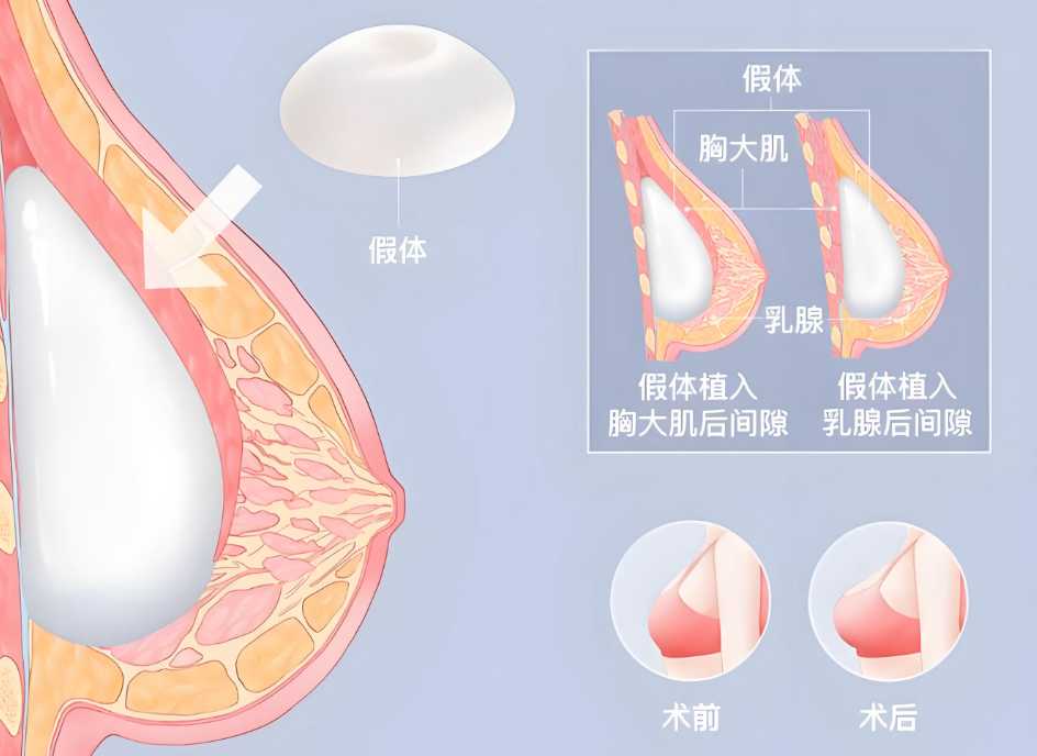 艾斯美假体一般寿命几年