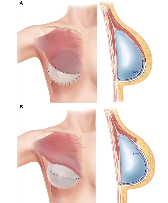 艾斯美假体是进口还是国产