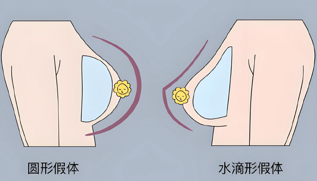 艾斯美假体好不好