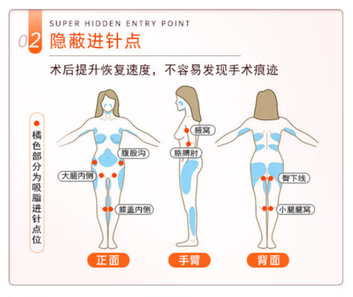 鄭州楊森醫(yī)生吸脂在哪個醫(yī)院