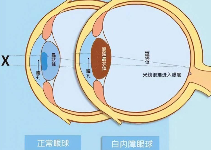 宜賓愛爾優(yōu)視眼科做白內(nèi)障如何？特色項目