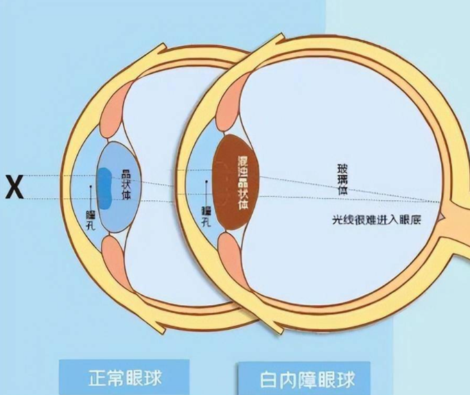 大悟愛爾眼科白內(nèi)障手術(shù)醫(yī)生如何？
