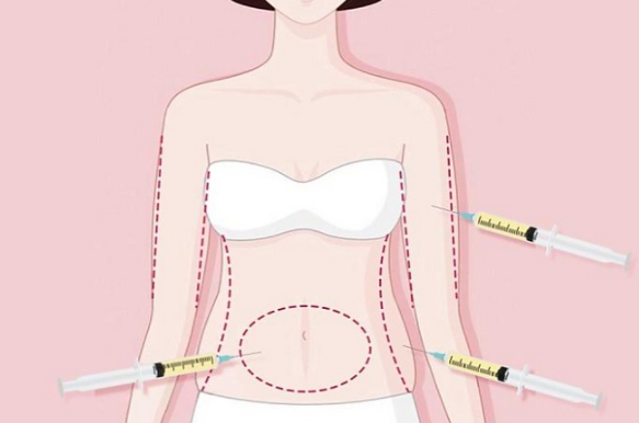 西安藝星的竇璽院長吸脂保守嗎？