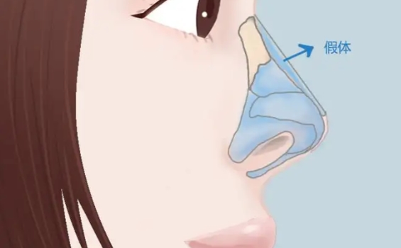 深圳陳桂飛做鼻子多少錢