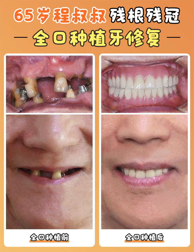 四、杭州亮貝美口腔醫(yī)院種植牙價(jià)格情況