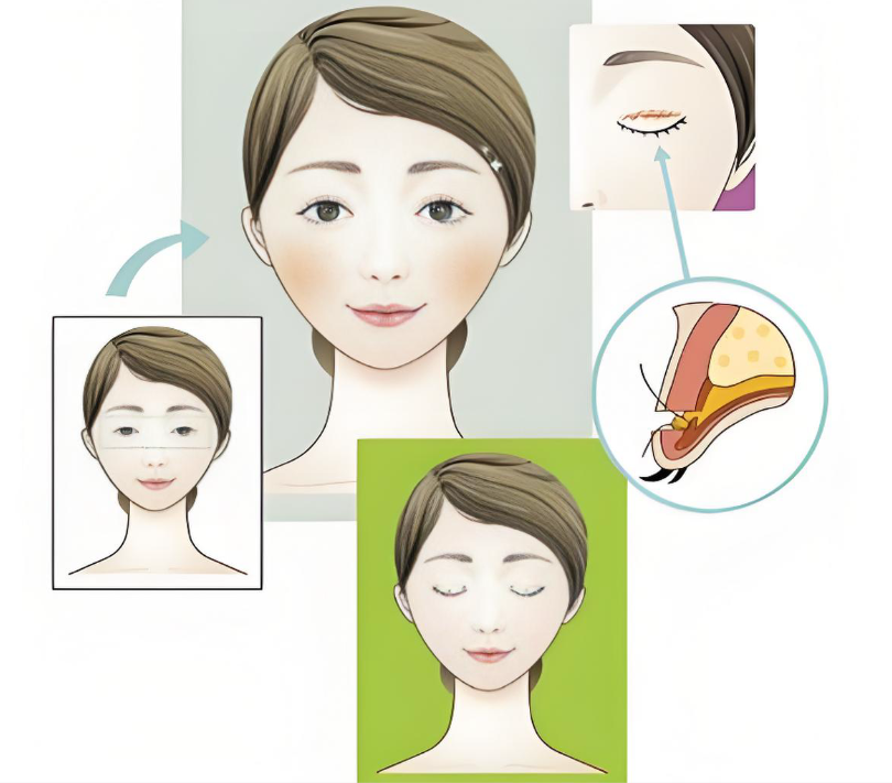 石家莊做內(nèi)雙眼皮手術(shù)價(jià)格