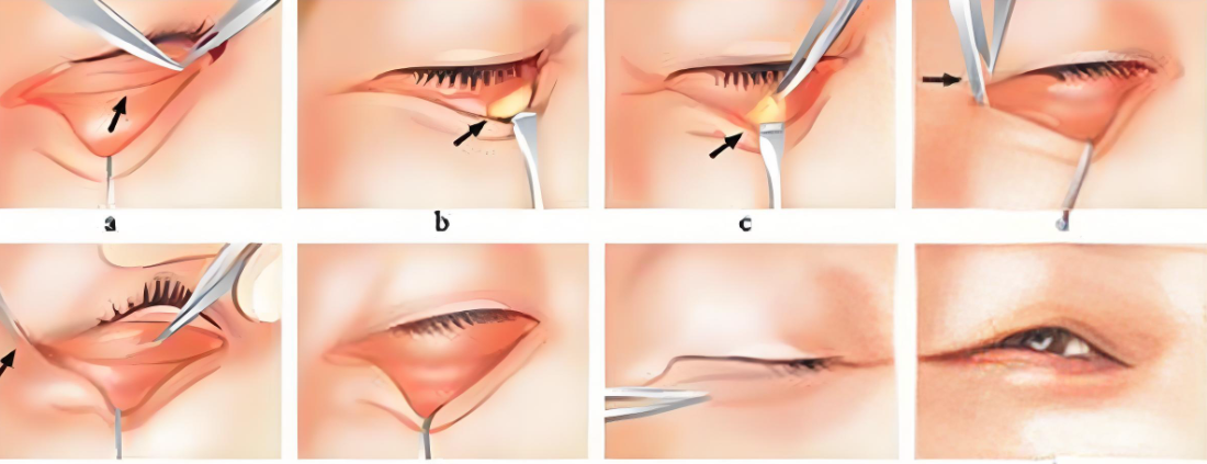 石家莊做內(nèi)雙眼皮手術(shù)醫(yī)院