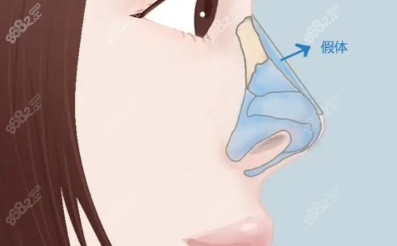 Fenty分體隆鼻假體