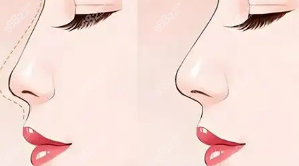 Fenty分體隆鼻假體