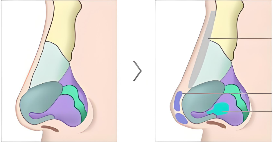 上海娜美王旭东做鼻子实例