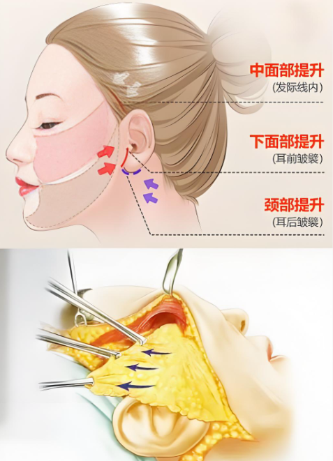 上海吕医生面部提升怎么样www.8682.cc