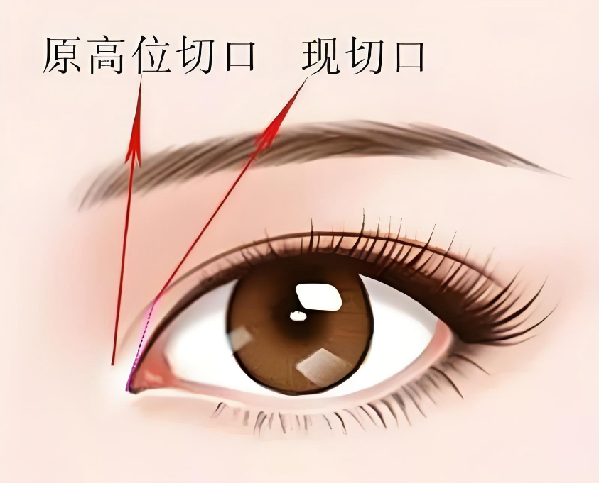 上海高冠云做双眼皮怎么样？高冠云割双眼皮自然，多位妹子晒出无美颜术后照