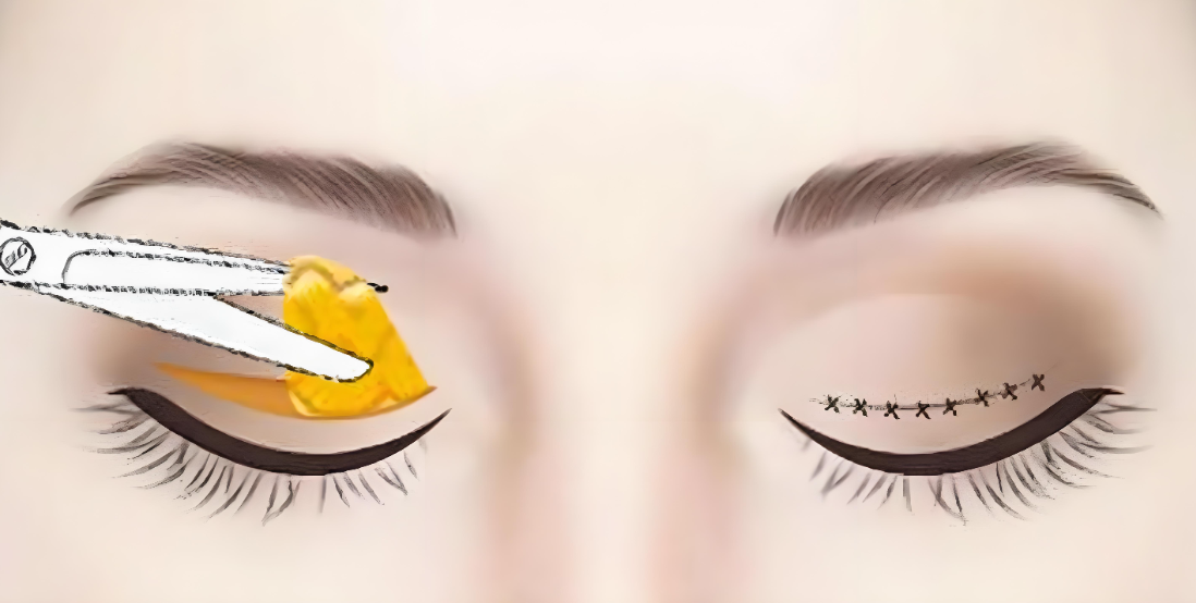 上海高冠云做双眼皮实例